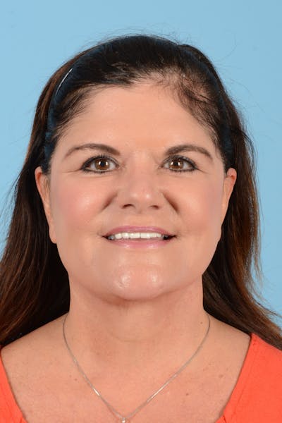 Facelift Before & After Gallery - Patient 214856 - Image 4