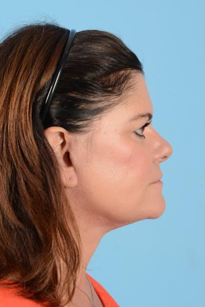 Facelift Before & After Gallery - Patient 214856 - Image 8