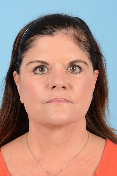 Facelift Before & After Gallery - Patient 214856 - Image 2