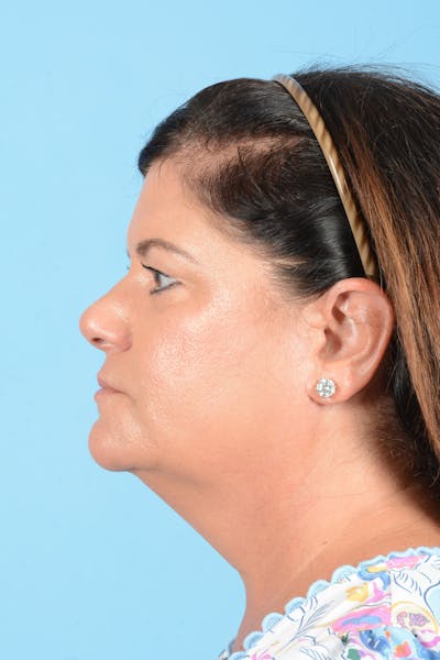 Facelift Before & After Gallery - Patient 214856 - Image 12