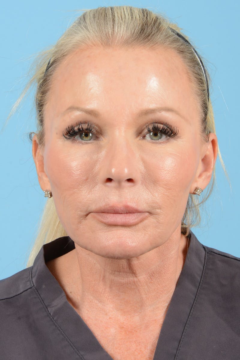 Facial Augmentation Before & After Gallery - Patient 159704 - Image 1