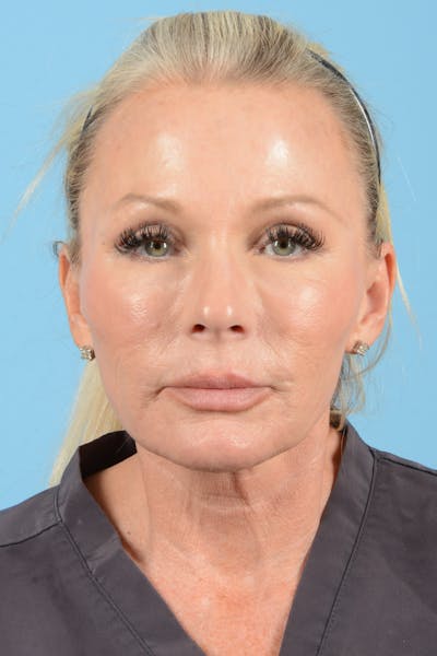 Facelift Before & After Gallery - Patient 320015 - Image 1