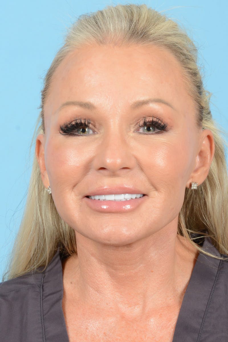 Facial Augmentation Before & After Gallery - Patient 159704 - Image 4