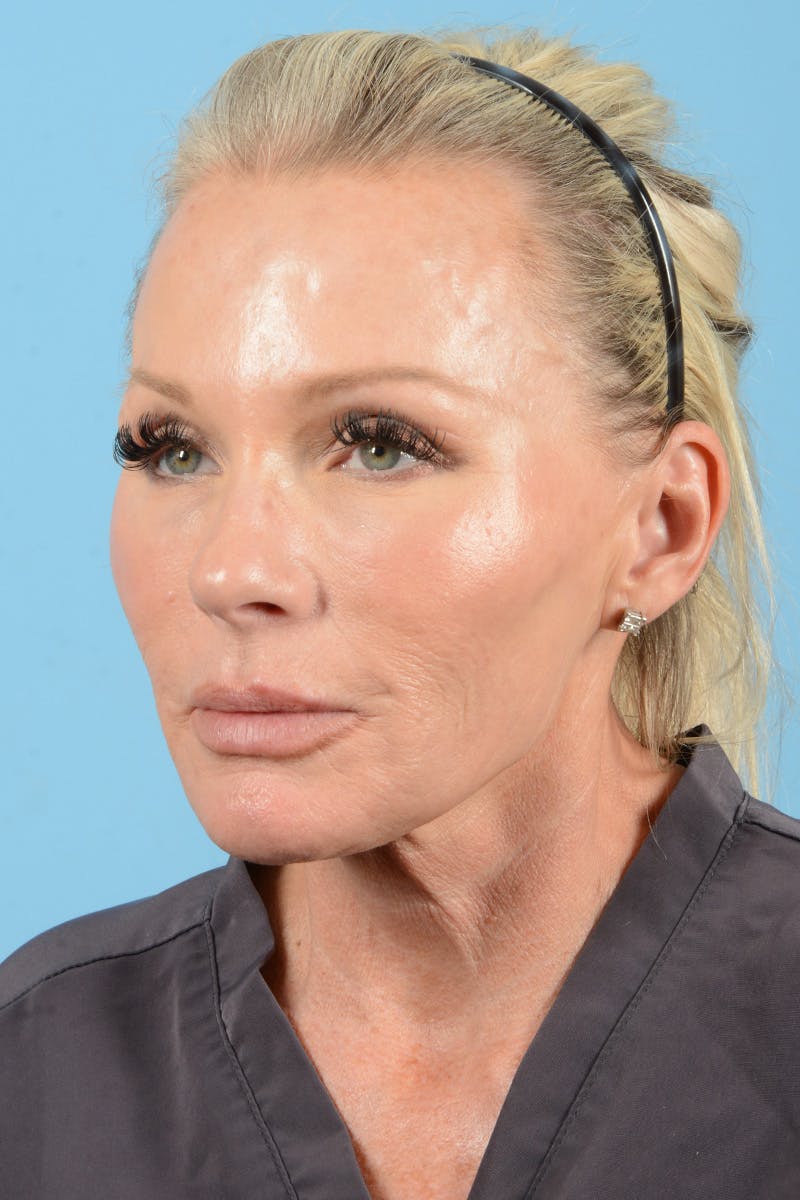 Facial Augmentation Before & After Gallery - Patient 159704 - Image 9