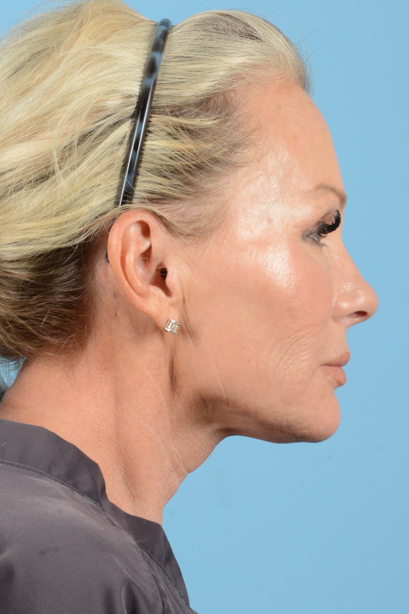 Facial Augmentation Before & After Gallery - Patient 159704 - Image 7