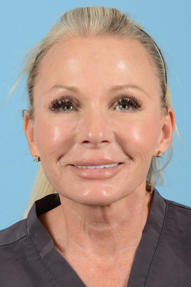 Facial Augmentation Before & After Gallery - Patient 159704 - Image 3