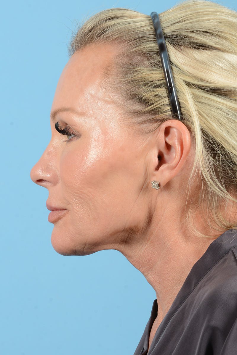 Facial Augmentation Before & After Gallery - Patient 159704 - Image 11