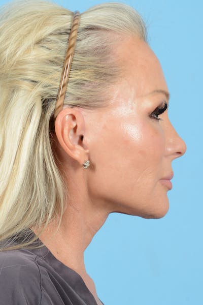 Facial Augmentation Before & After Gallery - Patient 159704 - Image 8