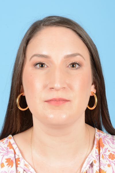 Rhinoplasty Before & After Gallery - Patient 150338 - Image 1