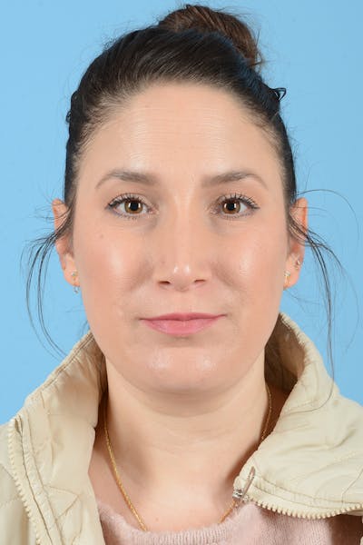 Rhinoplasty Before & After Gallery - Patient 150338 - Image 2