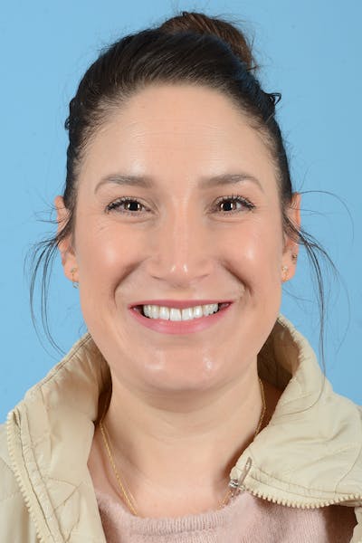 Rhinoplasty Before & After Gallery - Patient 150338 - Image 4