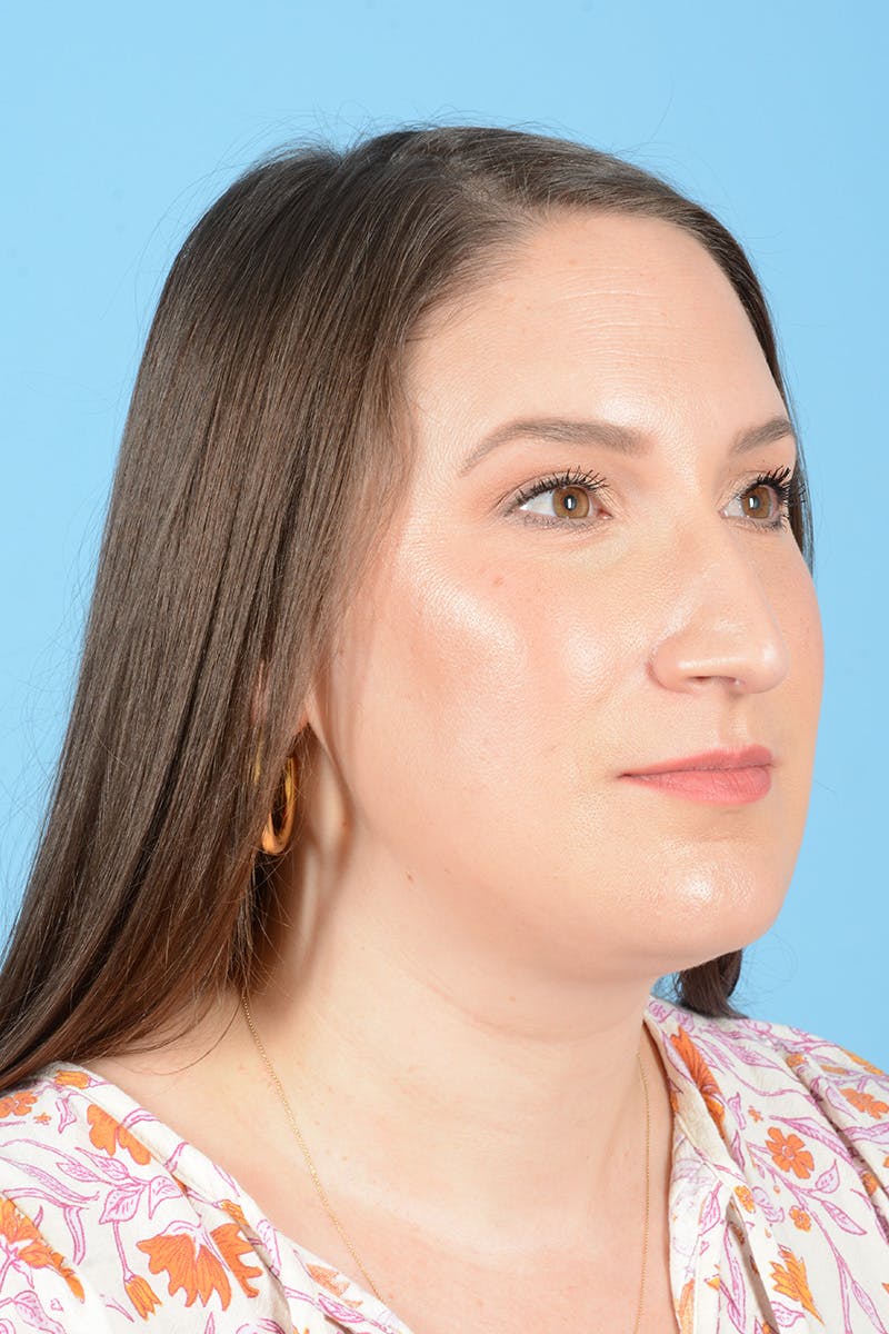 Rhinoplasty Before & After Gallery - Patient 150338 - Image 7