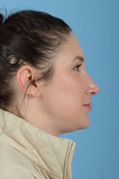 Rhinoplasty Before & After Gallery - Patient 150338 - Image 12