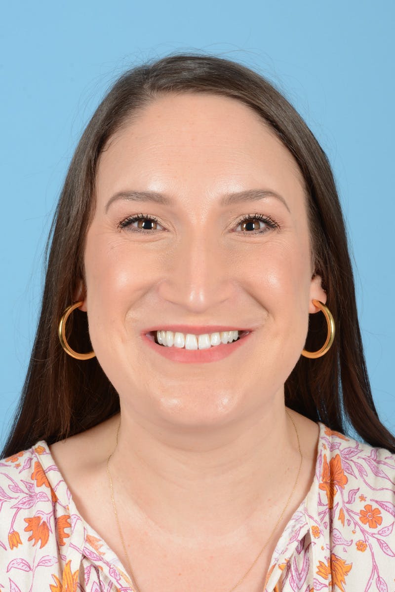 Rhinoplasty Before & After Gallery - Patient 150338 - Image 3