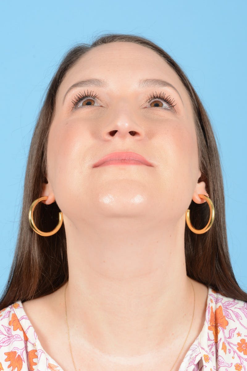 Rhinoplasty Before & After Gallery - Patient 150338 - Image 5