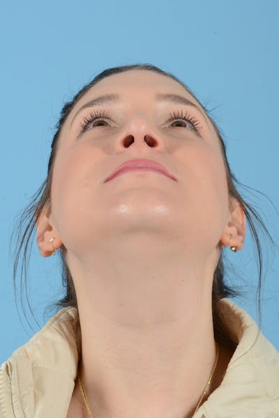 Rhinoplasty Before & After Gallery - Patient 150338 - Image 6