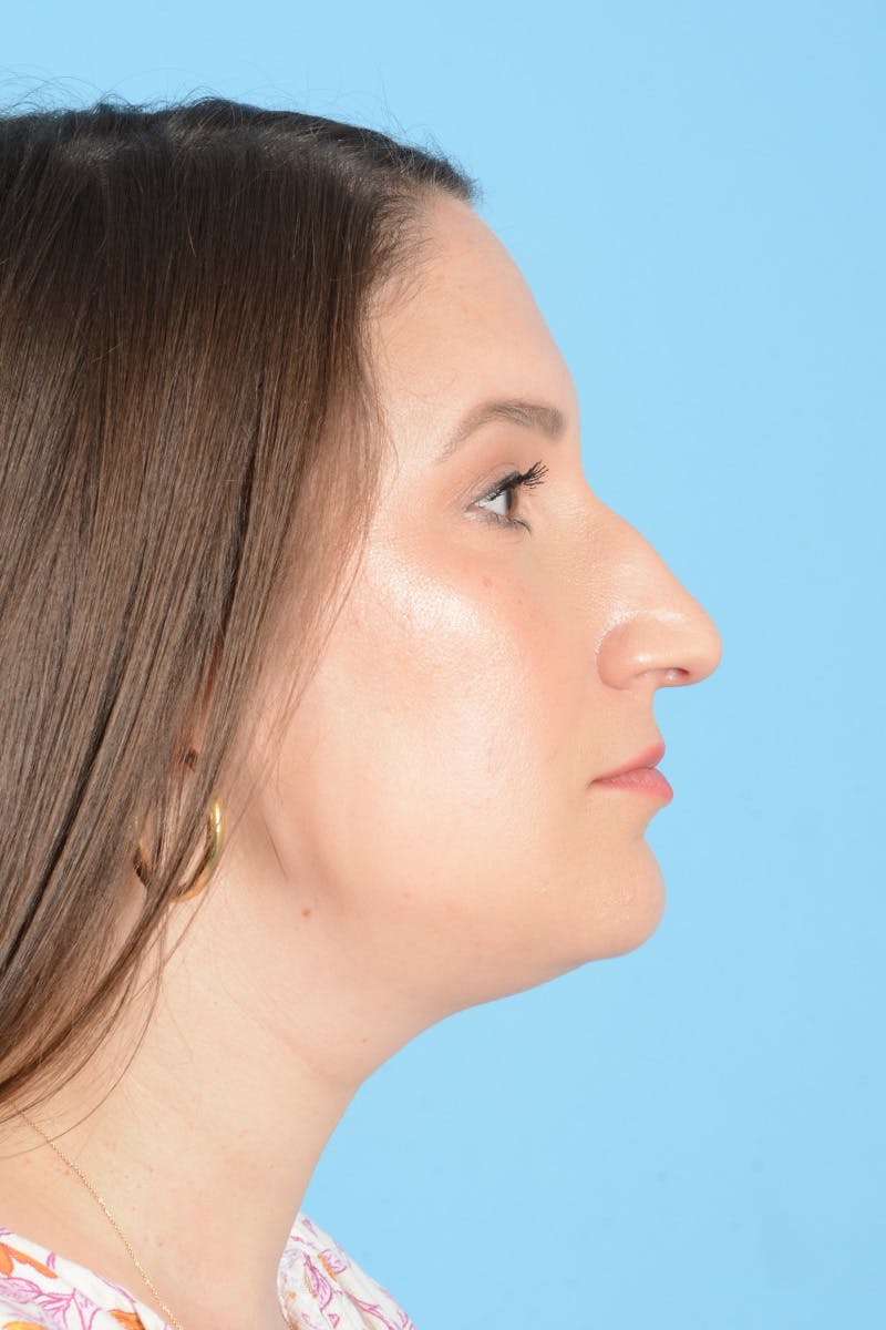 Rhinoplasty Before & After Gallery - Patient 150338 - Image 11