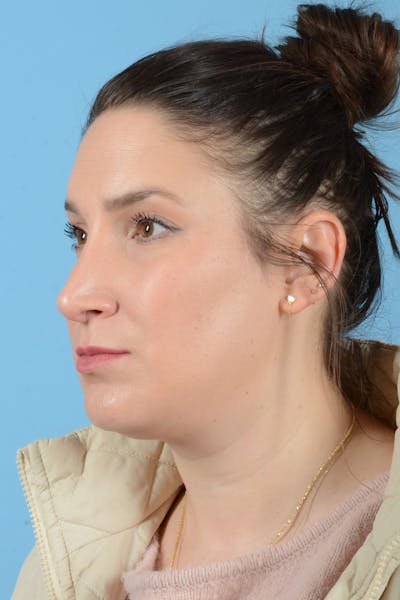 Rhinoplasty Before & After Gallery - Patient 150338 - Image 10