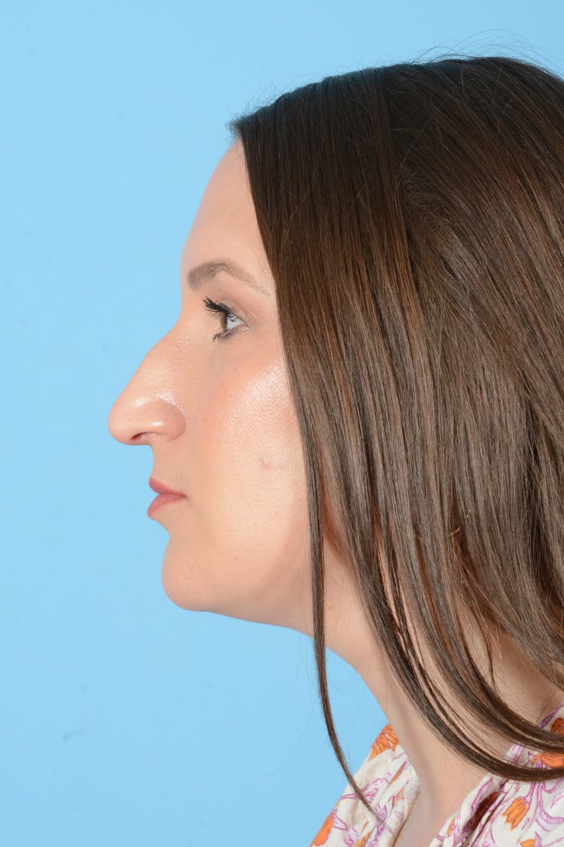 Rhinoplasty Before & After Gallery - Patient 150338 - Image 13