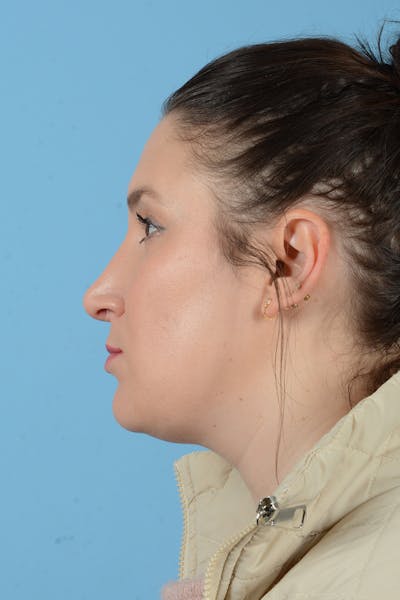 Rhinoplasty Before & After Gallery - Patient 150338 - Image 14