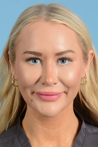 Rhinoplasty Before & After Gallery - Patient 338210 - Image 4