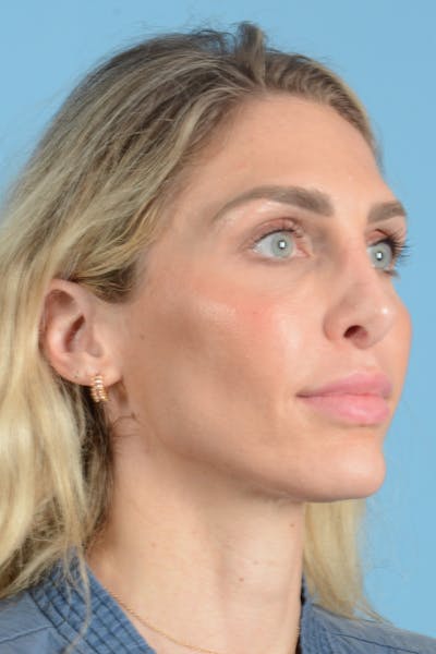 Rhinoplasty Before & After Gallery - Patient 249686 - Image 6