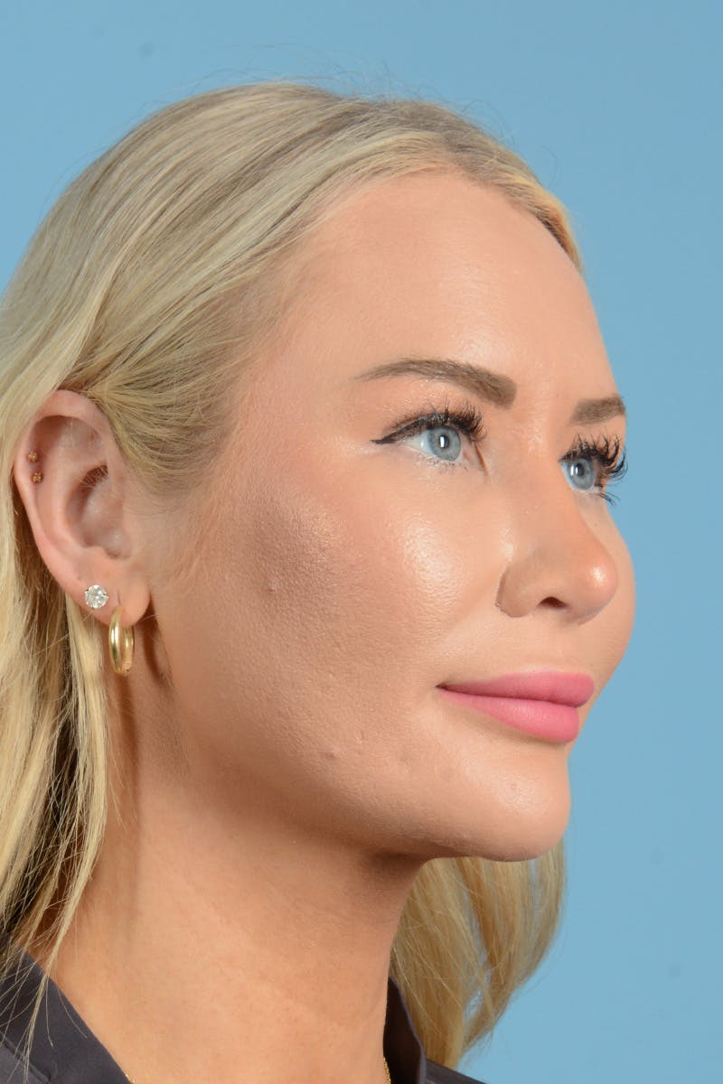 Rhinoplasty Before & After Gallery - Patient 338210 - Image 6