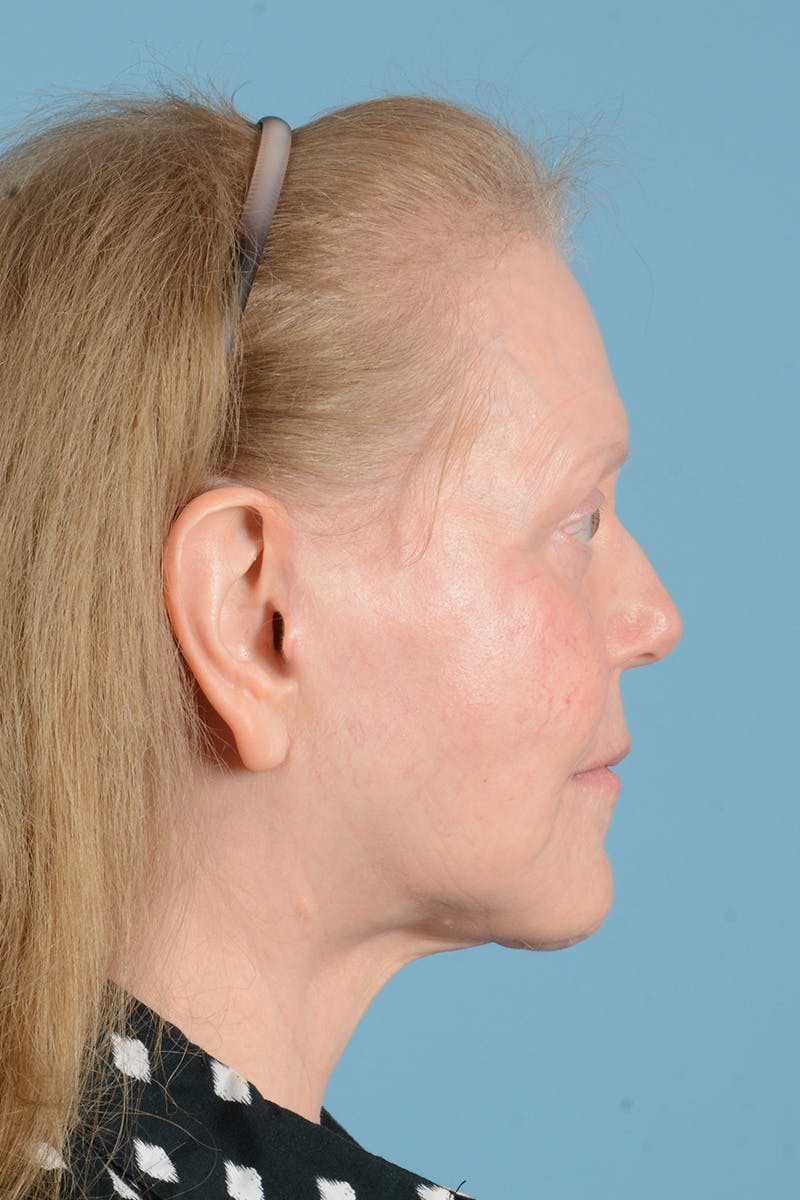 Facelift Before & After Gallery - Patient 422480 - Image 10