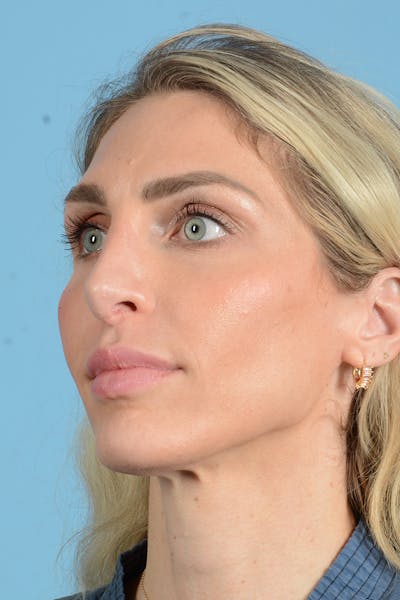 Rhinoplasty Before & After Gallery - Patient 249686 - Image 10