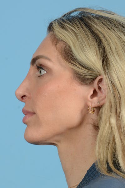 Rhinoplasty Before & After Gallery - Patient 249686 - Image 12