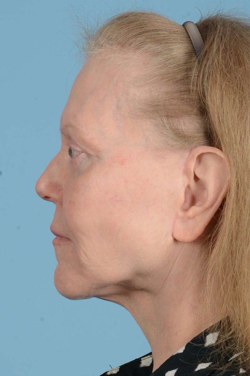 Facelift Before & After Gallery - Patient 422480 - Image 12