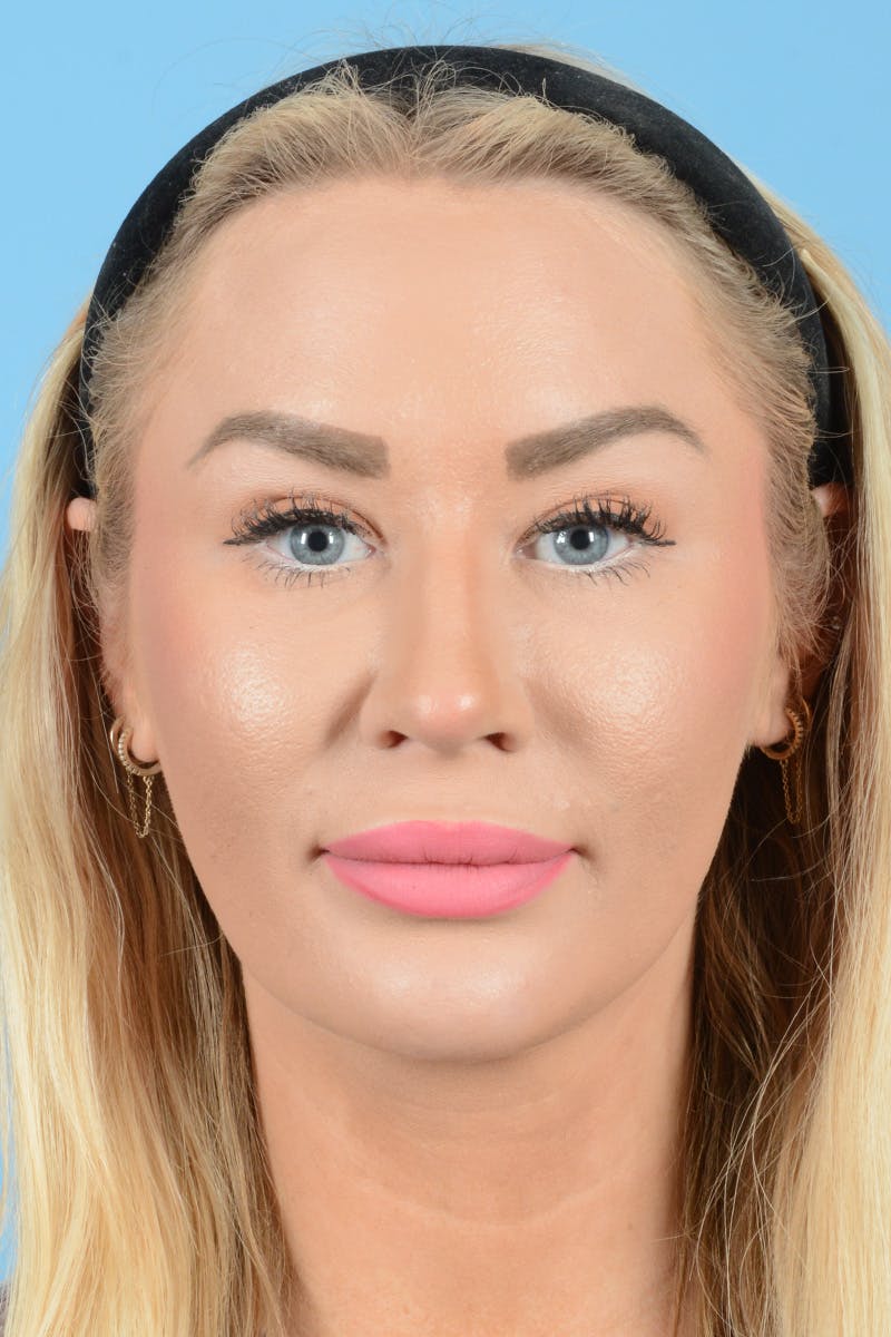 Rhinoplasty Before & After Gallery - Patient 338210 - Image 1