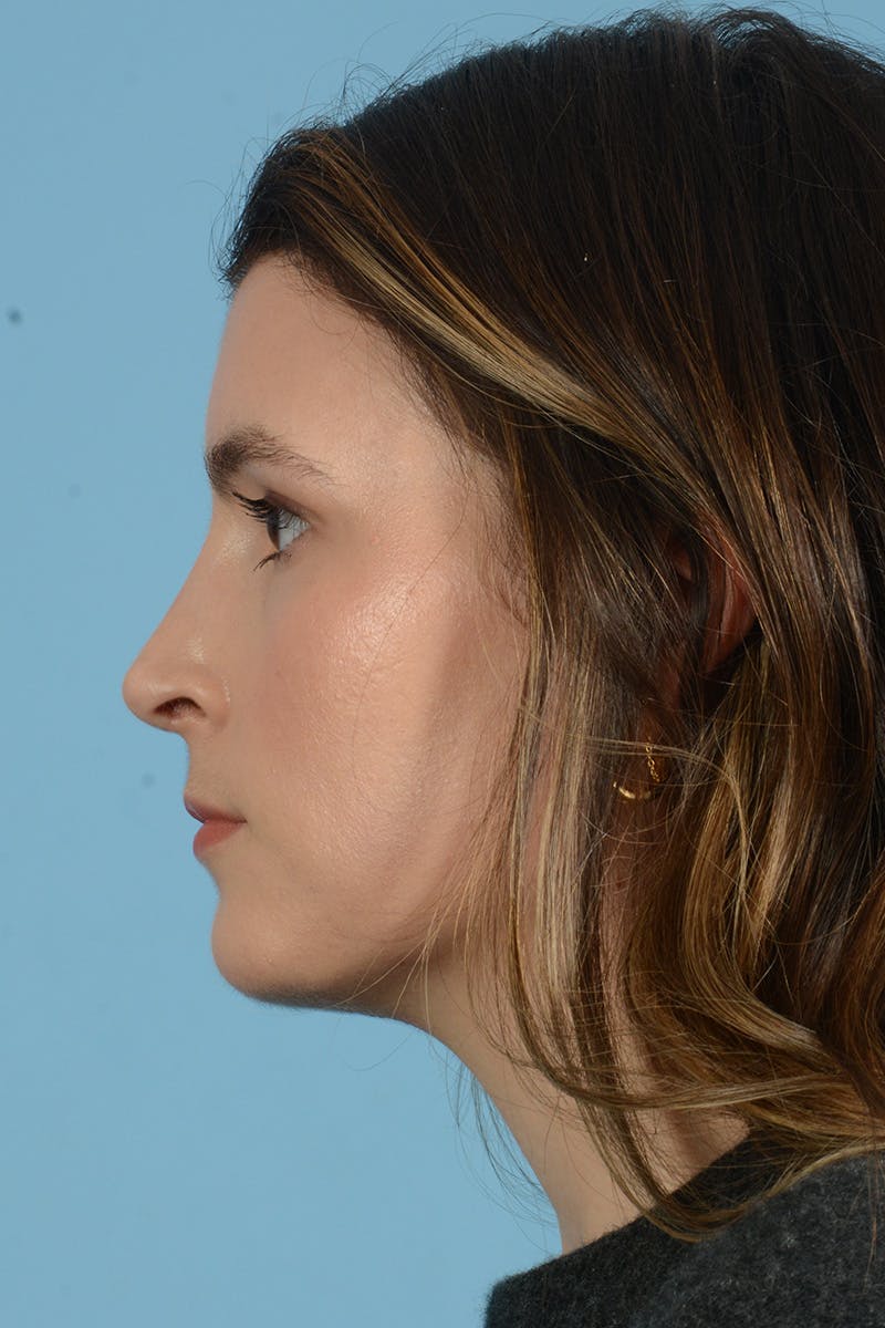 Rhinoplasty Before & After Gallery - Patient 316264 - Image 10