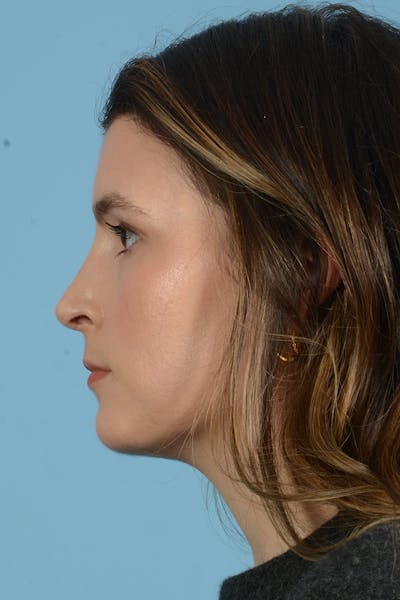 Rhinoplasty Before & After Gallery - Patient 316264 - Image 10
