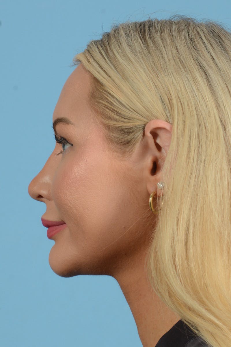 Rhinoplasty Before & After Gallery - Patient 338210 - Image 12
