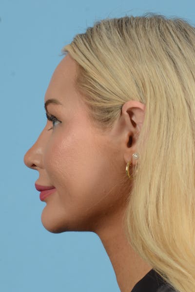 Rhinoplasty Before & After Gallery - Patient 338210 - Image 12