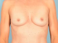 Breast Augmentation Before & After Gallery - Patient 170573 - Image 1