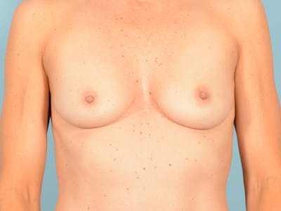 Breast Augmentation Before & After Gallery - Patient 170573 - Image 1