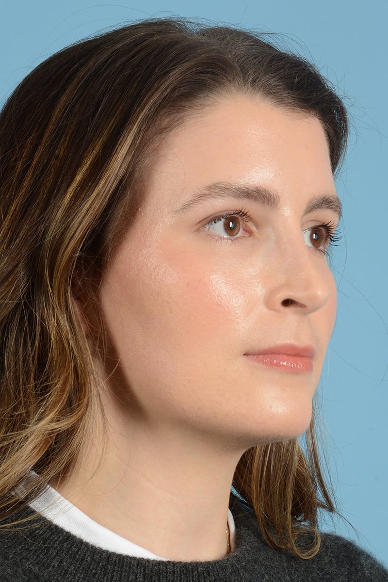 Rhinoplasty Before & After Gallery - Patient 316264 - Image 4