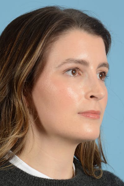 Rhinoplasty Before & After Gallery - Patient 316264 - Image 4