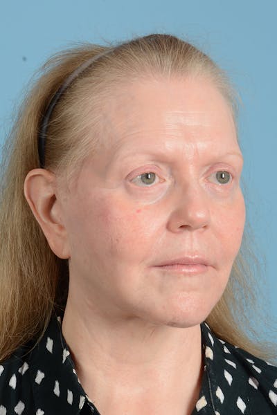Facelift Before & After Gallery - Patient 422480 - Image 6