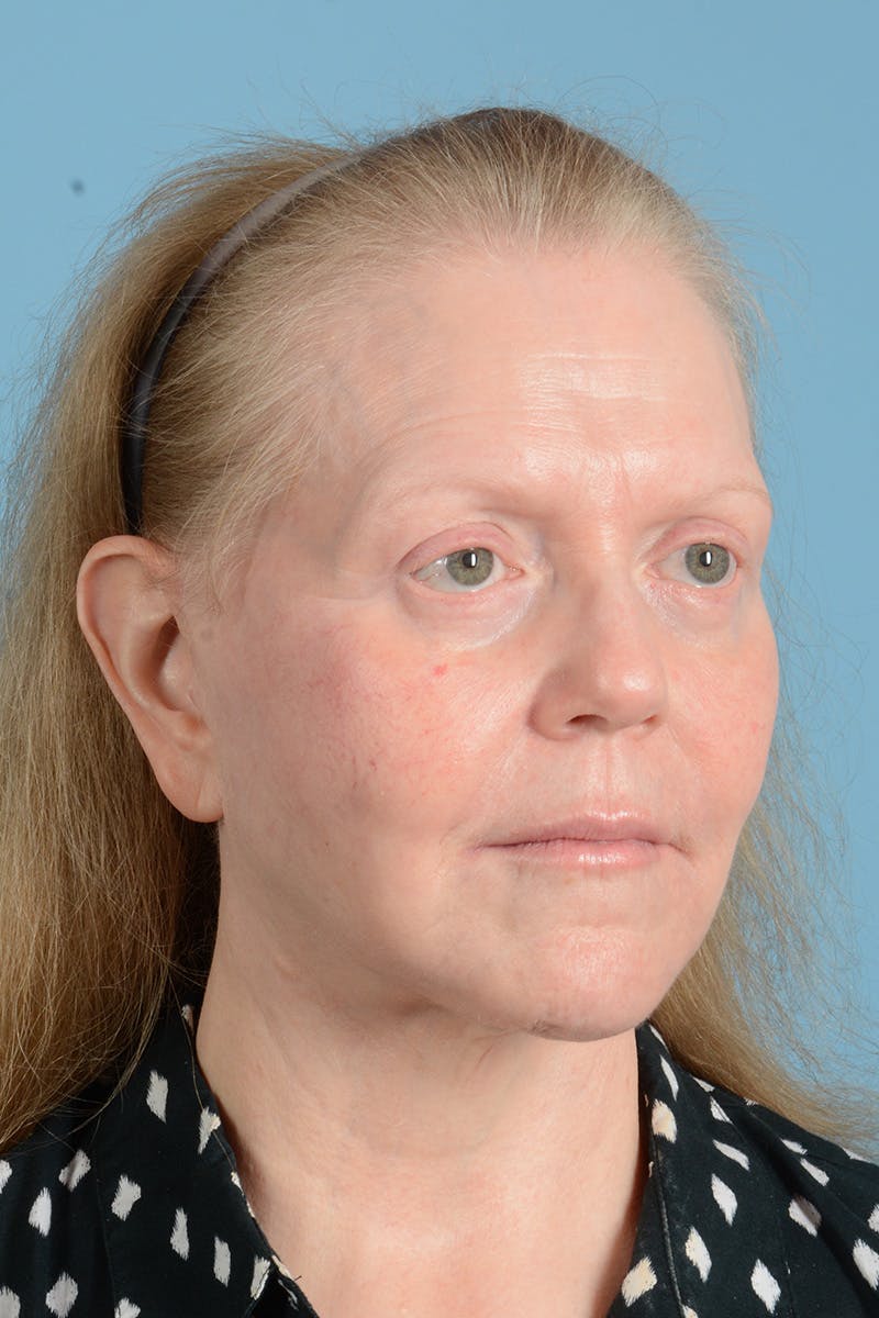 Facelift Before & After Gallery - Patient 422480 - Image 6