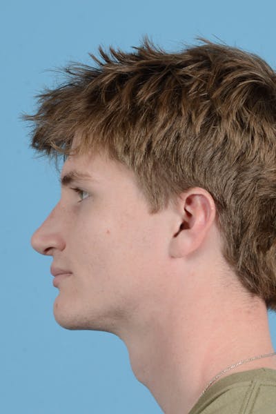 Rhinoplasty Before & After Gallery - Patient 156634 - Image 12