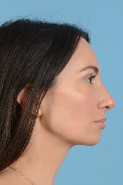 Rhinoplasty Before & After Gallery - Patient 312442 - Image 8