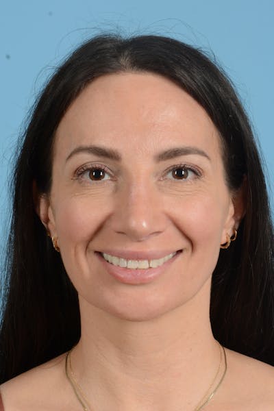 Rhinoplasty Before & After Gallery - Patient 312442 - Image 4