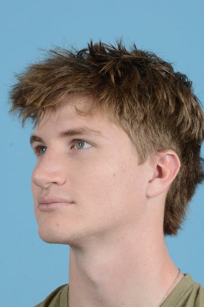 Rhinoplasty Before & After Gallery - Patient 156634 - Image 10