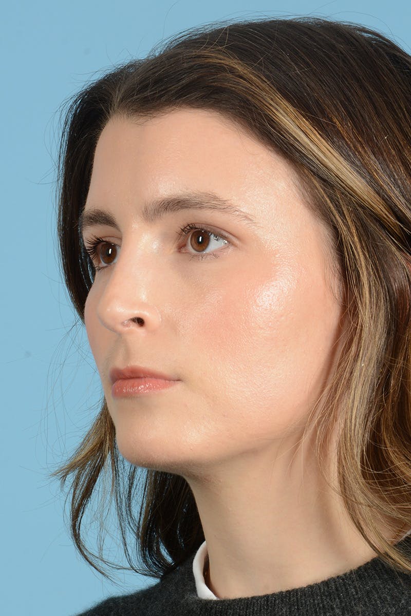 Rhinoplasty Before & After Gallery - Patient 316264 - Image 8