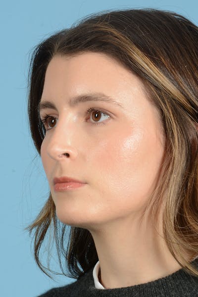 Rhinoplasty Before & After Gallery - Patient 316264 - Image 8