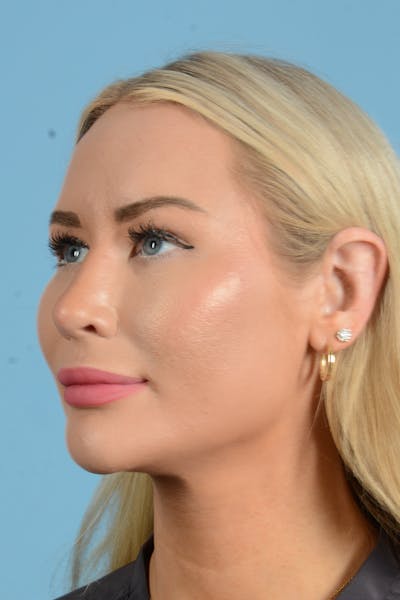Rhinoplasty Before & After Gallery - Patient 338210 - Image 10