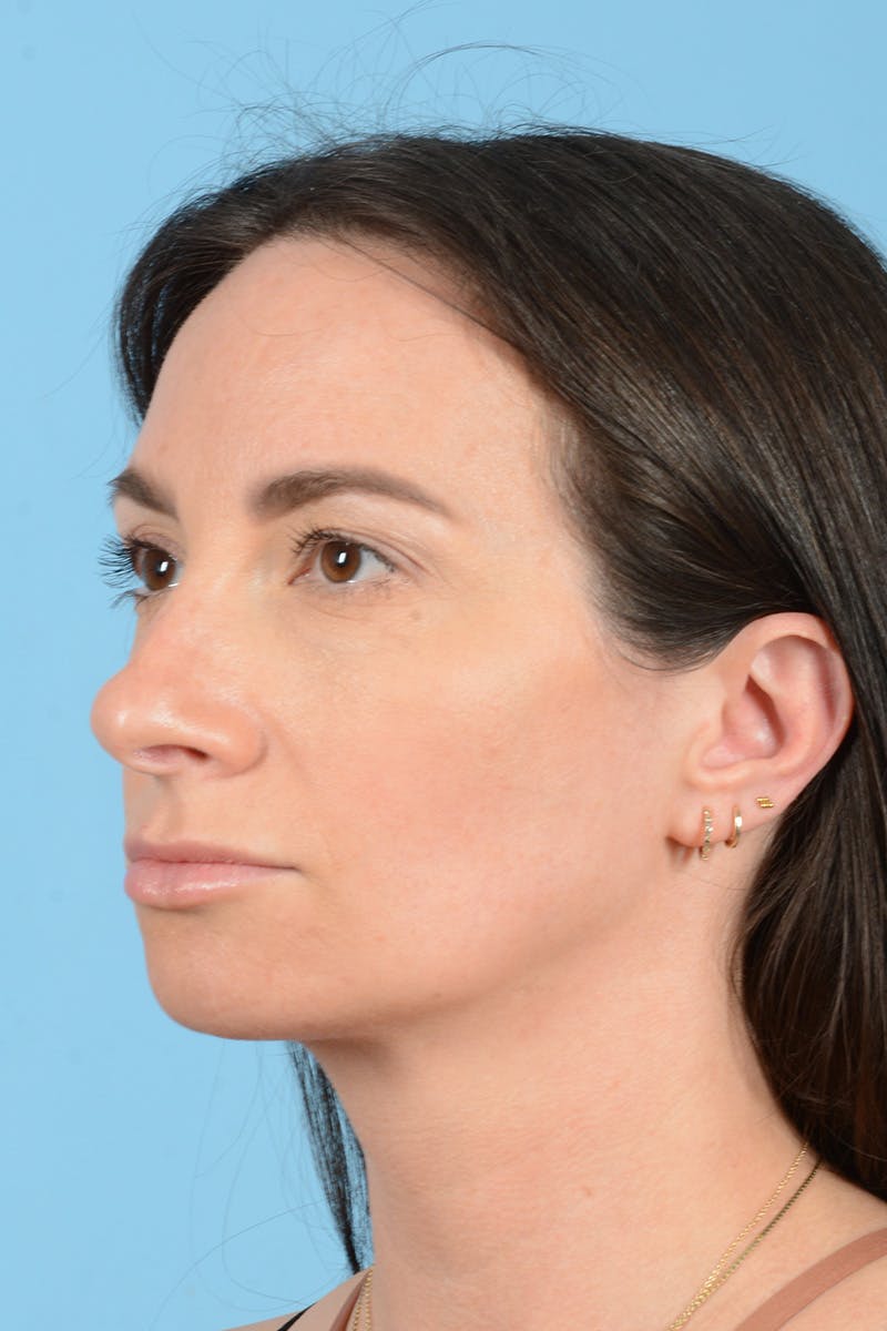 Rhinoplasty Before & After Gallery - Patient 312442 - Image 9